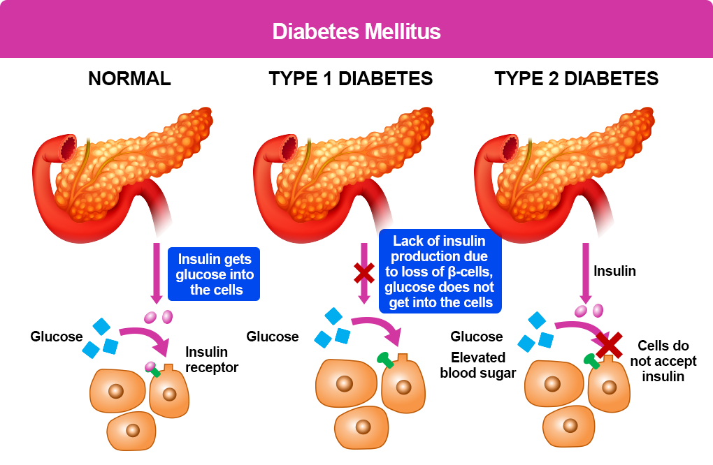diabetes mellitus illustration